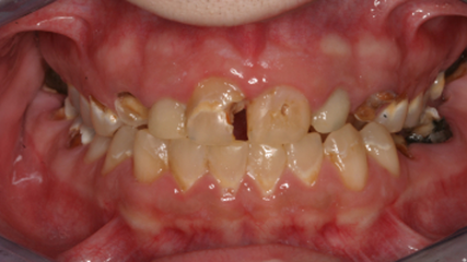 photo of severe decay on teeth