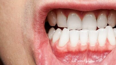 Photo showing up close gums and teeth with some recessions
