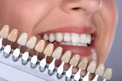 dental shade matching