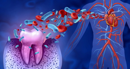 Periodontitis Linked to Atrial Fibrosis