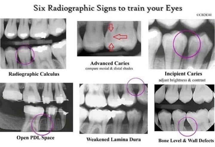 Photo of 6 different radiographic signs to train your eyes.