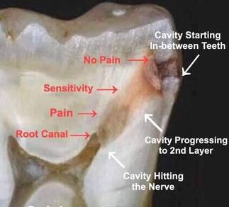 Picture of the stages of tooth decay